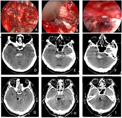 Case Report: Endoscopic trans-cerebellar medullary fissure approach for the management of brainstem hemorrhage